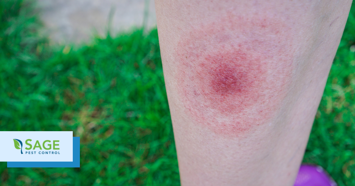 bite with bullseye rash from a tick with lyme disease